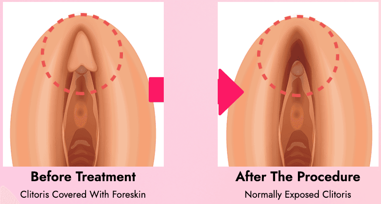 cost clitoroplasty korea