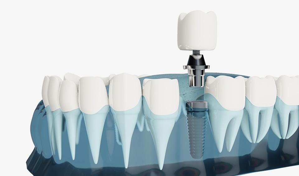 clear choice dental implants korea