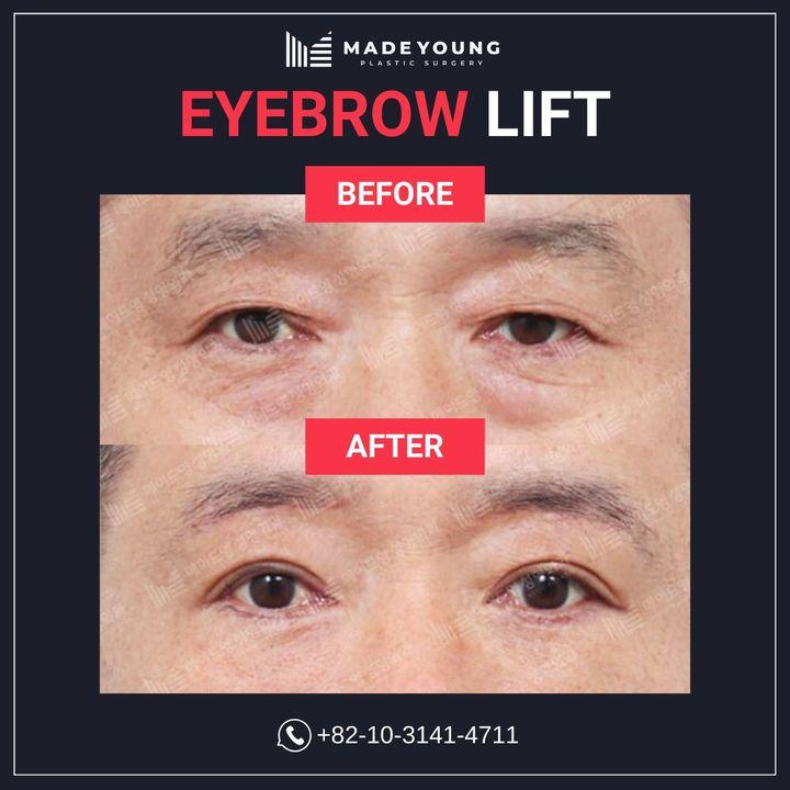 cost eyebrow lift korea