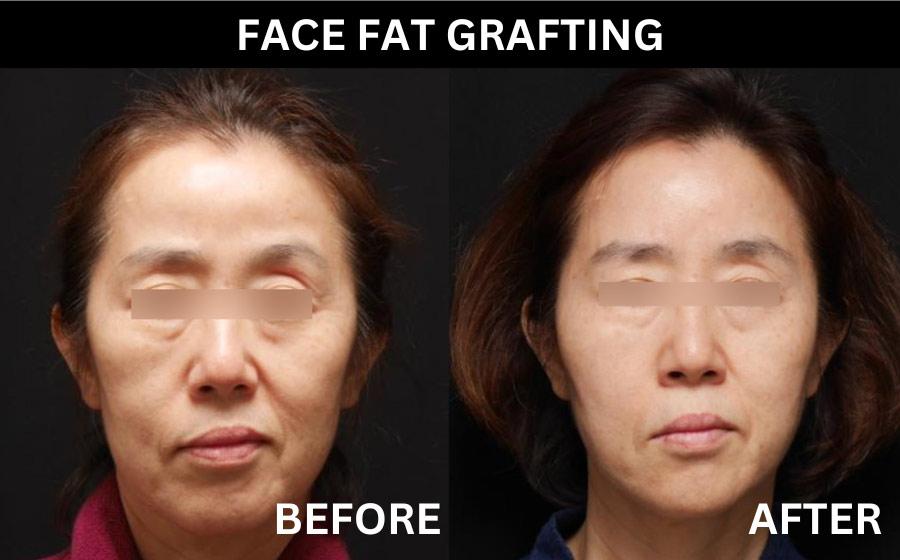 cost face fat grafting korea