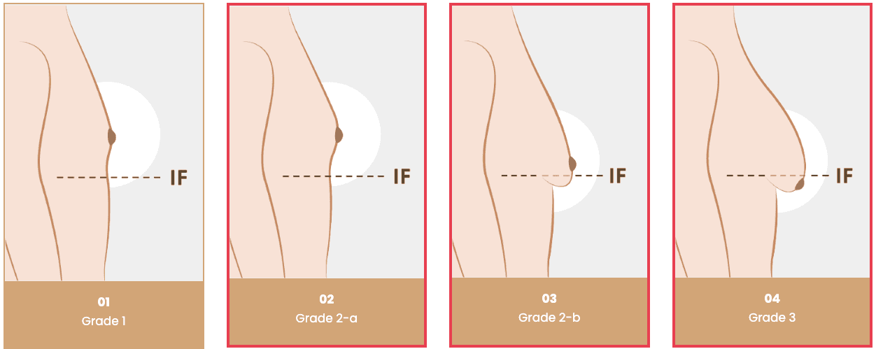 cost gynecomastia korea