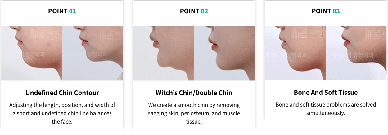 cost chin surgery korea