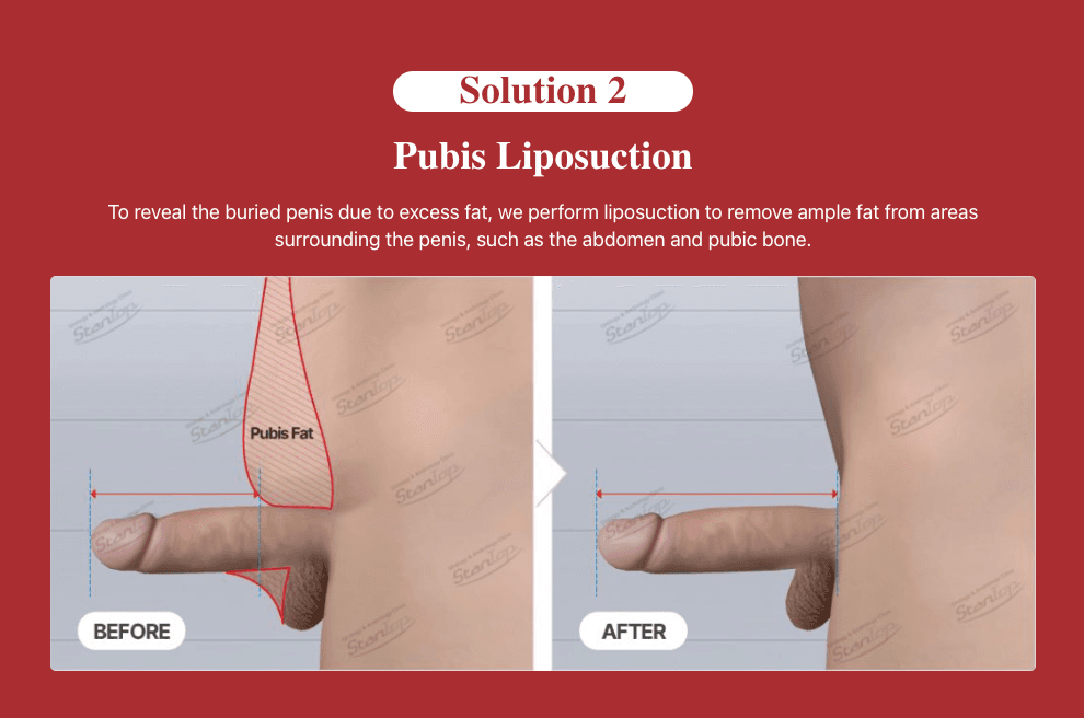 cost pubic fat pad removal korea