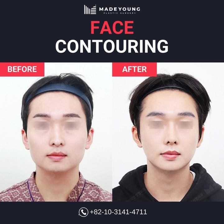 cost face contouring korea