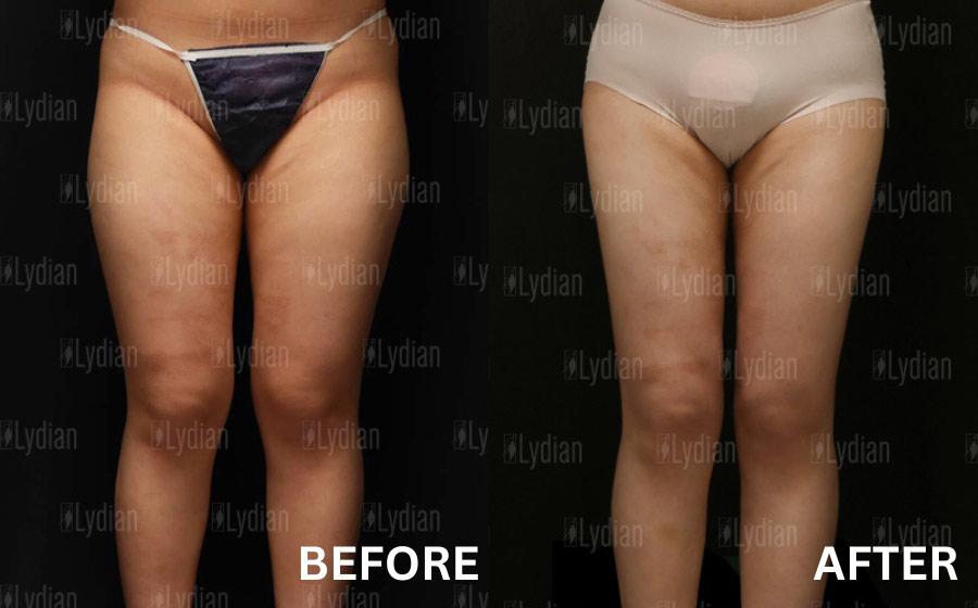 cost thigh liposuction korea