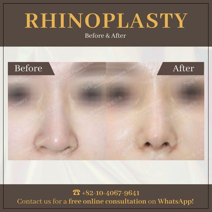 sauna after rhinoplasty