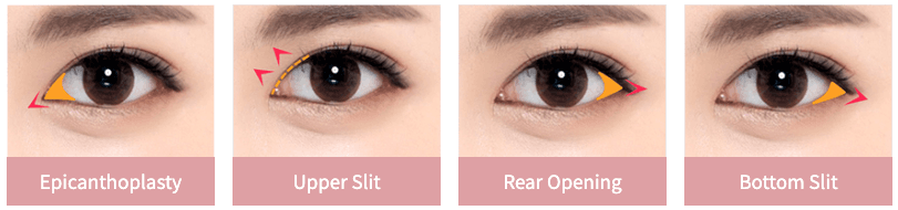 cost canthoplasty korea