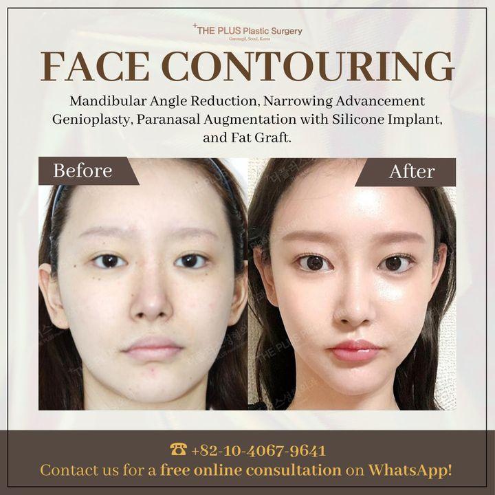 cost face contouring korea