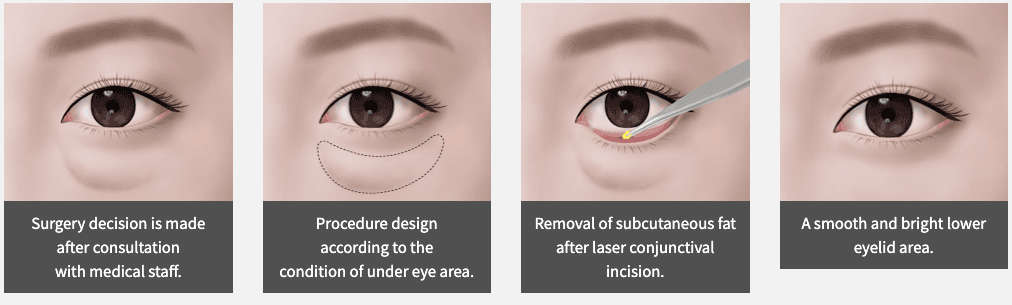 under eye fat removal korea