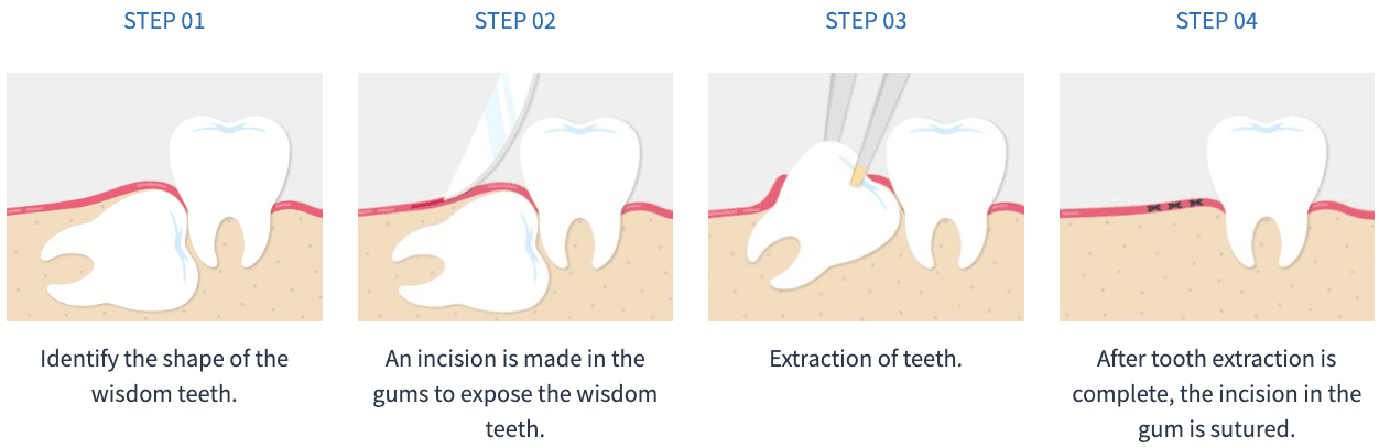 wisdom tooth removal korea