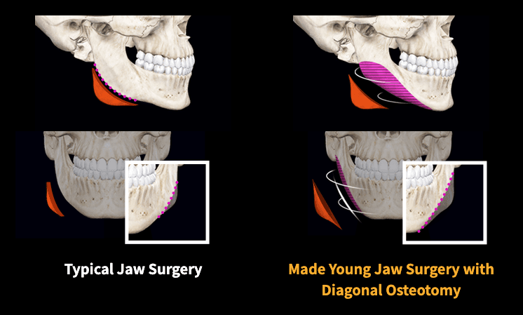 cost square jaw surgery korea