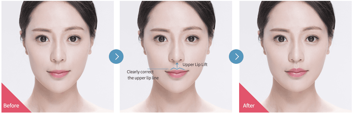 cost philtrum reduction surgery korea