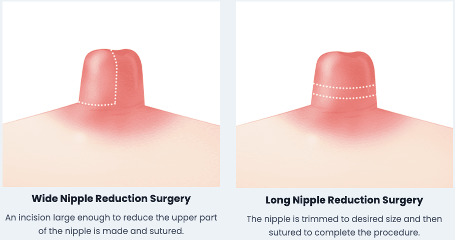 nipple surgery korea