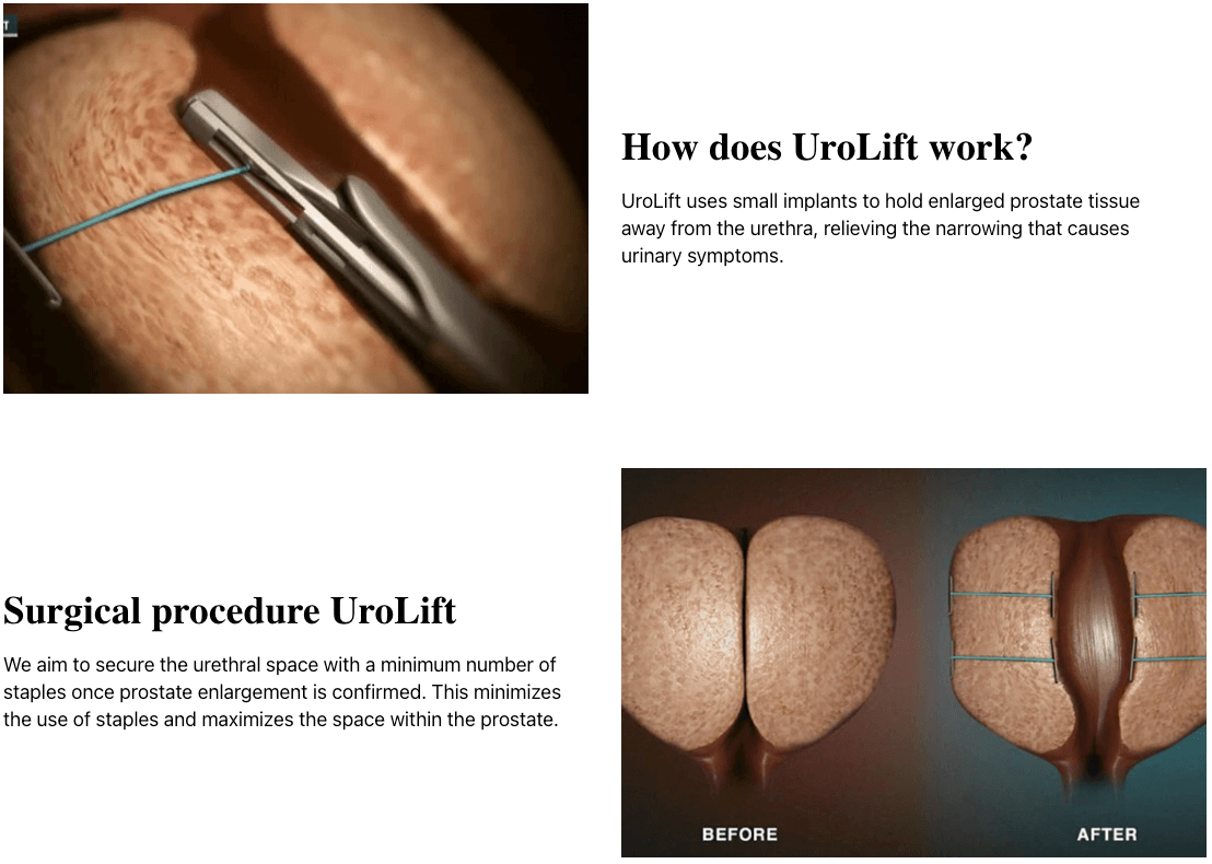 urolift korea