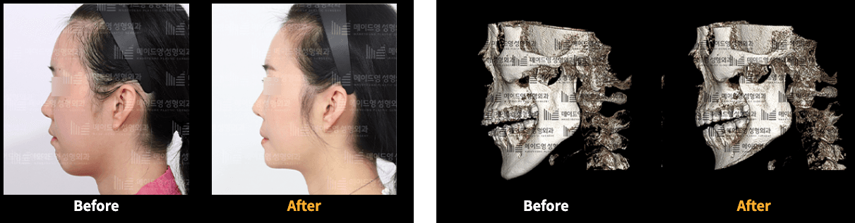 cost chin surgery korea