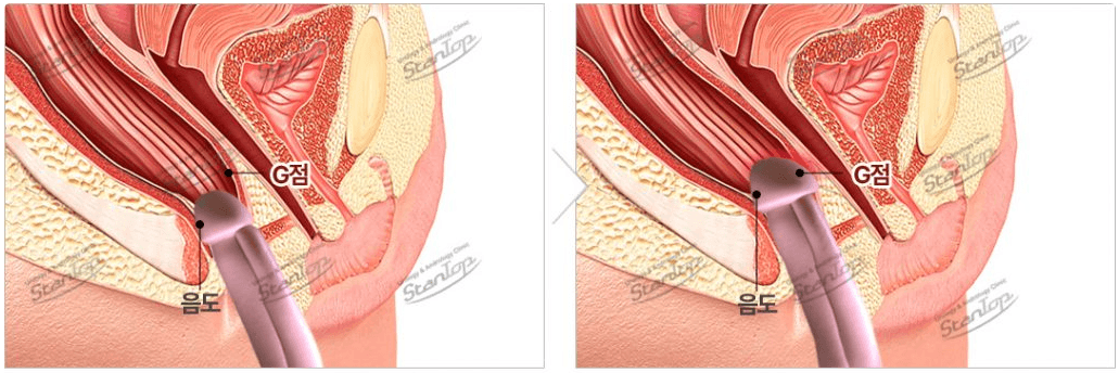 cost penis lengthening korea