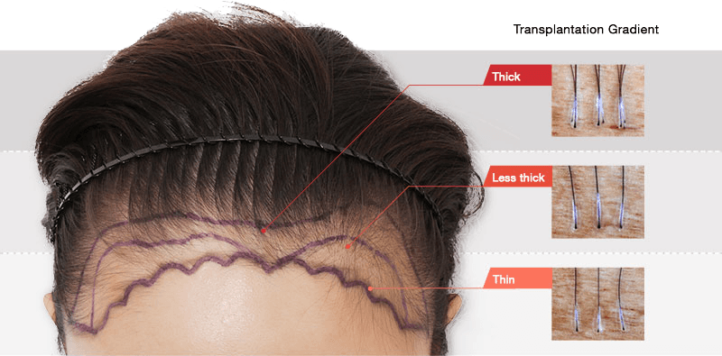 cost hair loss treatment korea