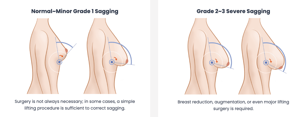 cost breast lift korea