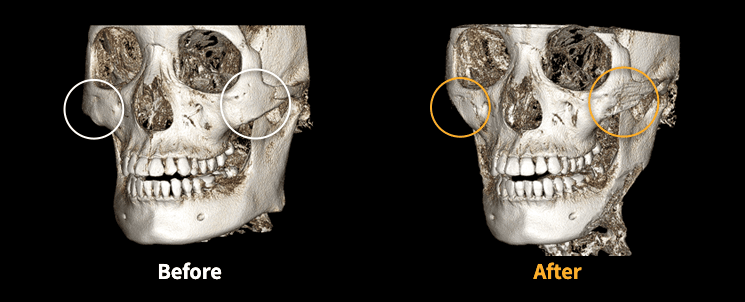 cheekbone reduction surgery in korea