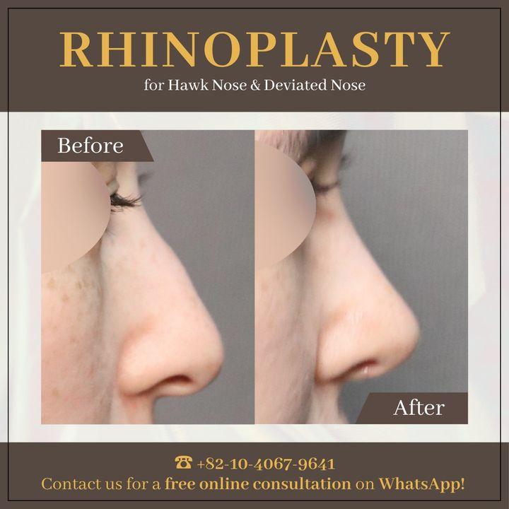 rhinoplasty korea