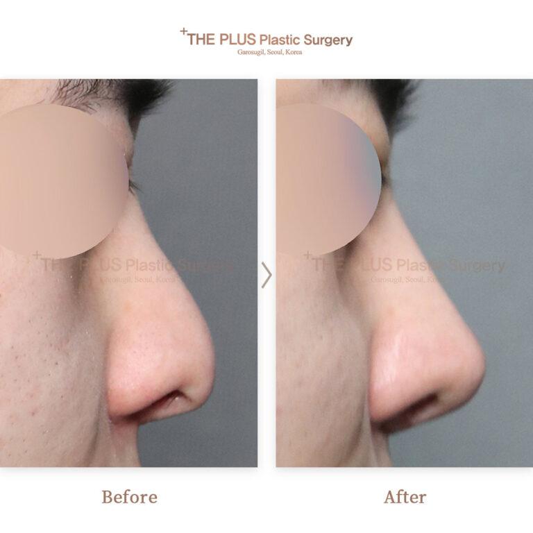 revision rhinoplasty in korea