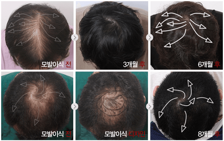 cost hair loss treatment korea