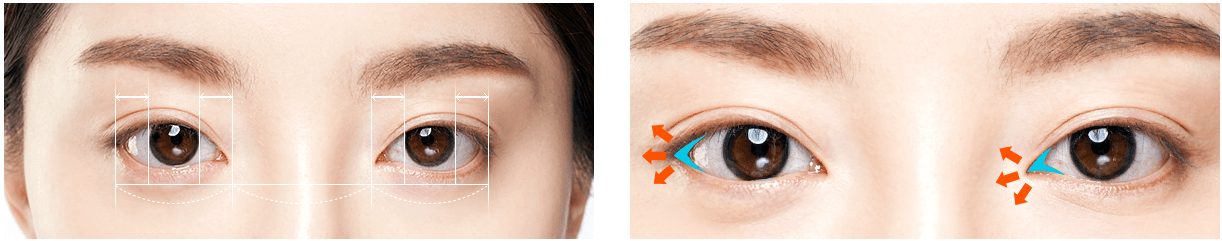 cost canthoplasty korea