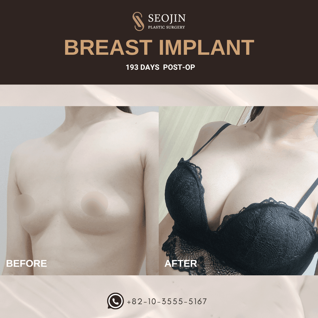 breast implant in korea