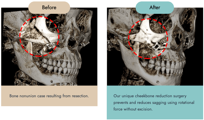 cost cheekbone reduction korea