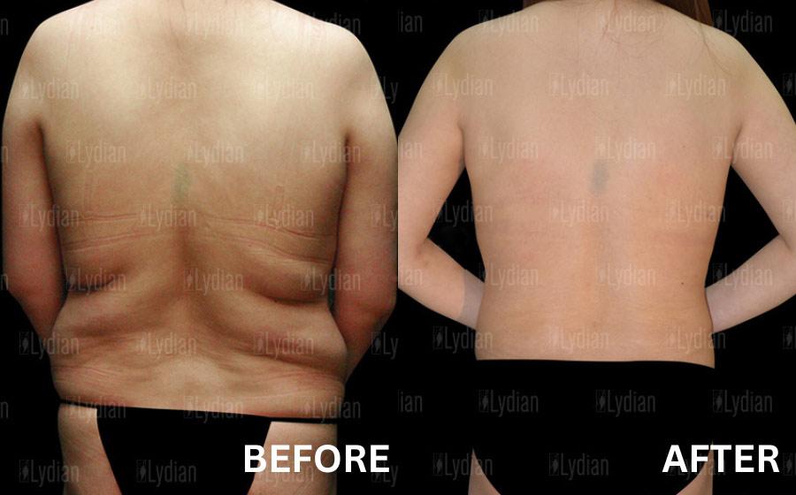 cost back liposuction korea