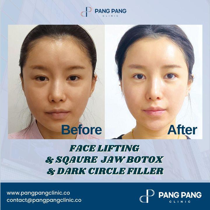 cost facial botox korea