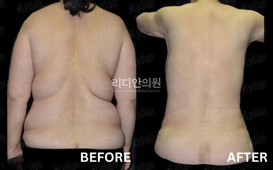 liposuction in korea