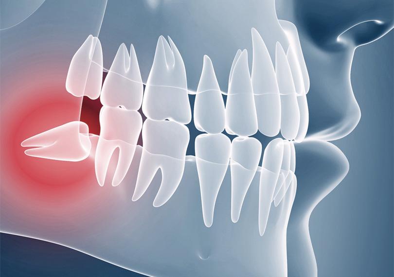 wisdom tooth removal korea