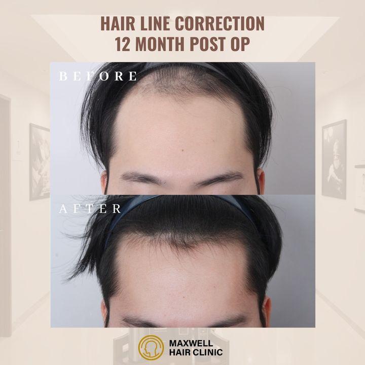 cost hairline correction korea