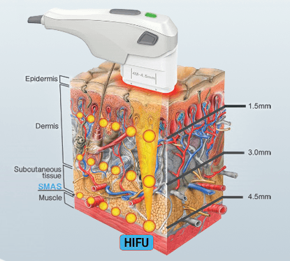 cost hifu laser korea