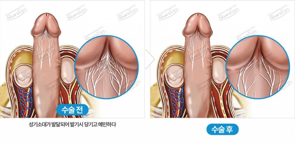 premature ejaculation korea