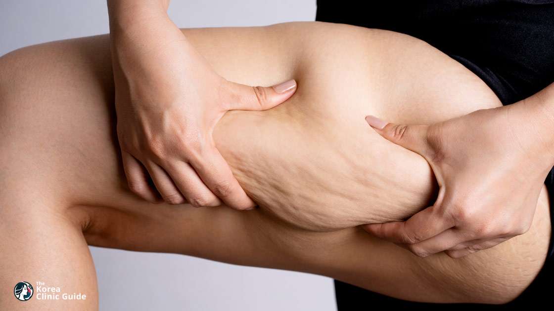 Thigh Liposuction in Korea: Methods, Recovery, Travel Planning, and Risks