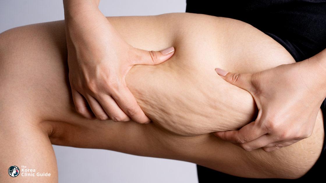 Thigh Liposuction in Korea: Methods, Recovery, Travel Planning, and Risks
