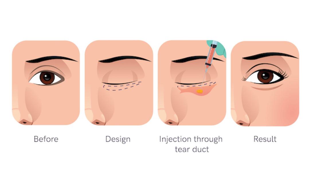 Love Band Surgery in Korea: Methods, Recovery, Risks and Travel Planning