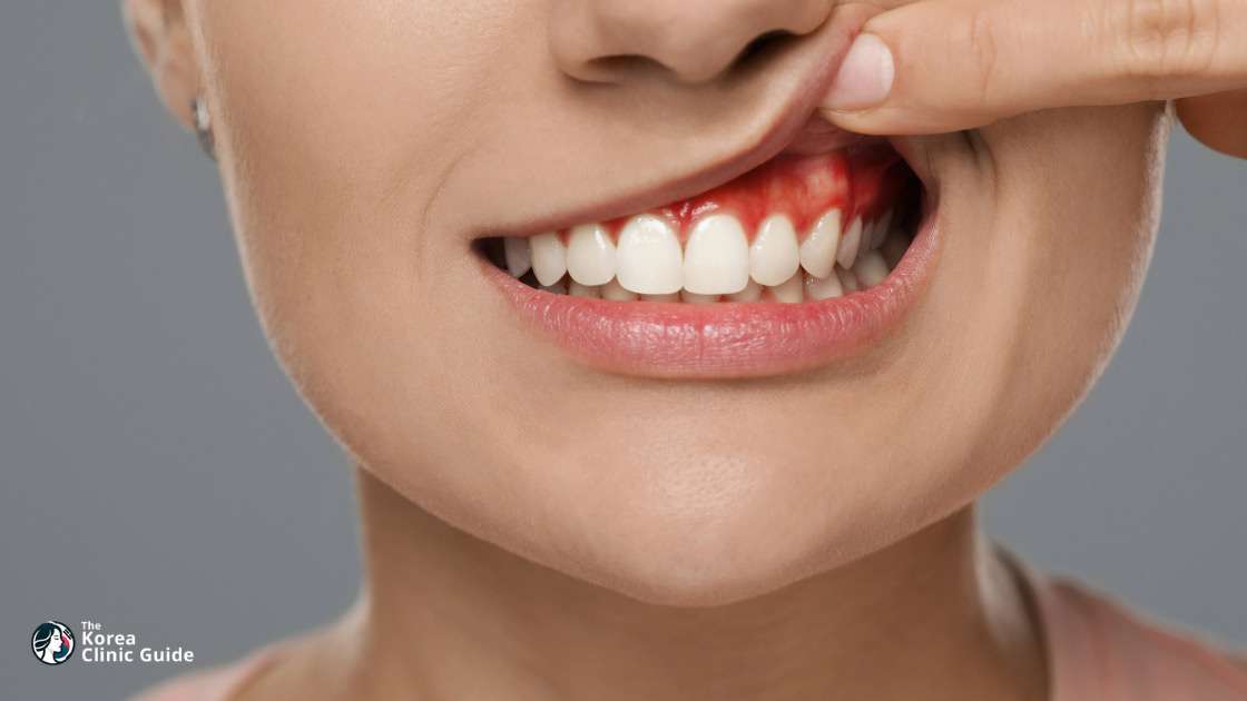 Gummy Smile Surgery in Korea: Causes, Treatment Methods, Recovery and Travel Planning
