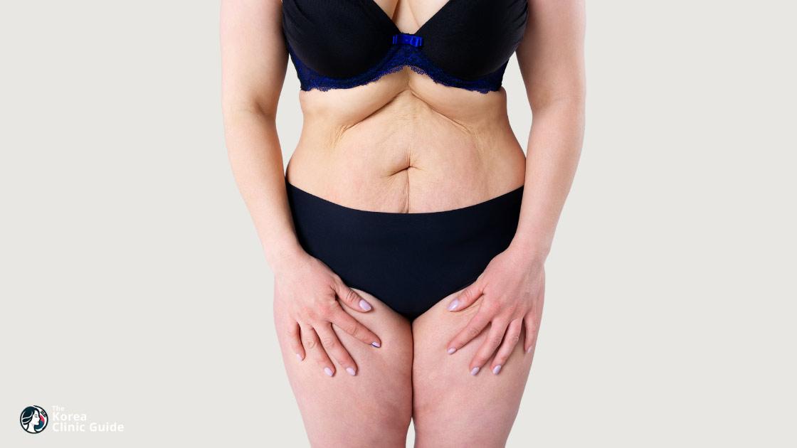Revision Liposuction in Korea: Methods, Recovery, Travel Planning, and Alternatives
