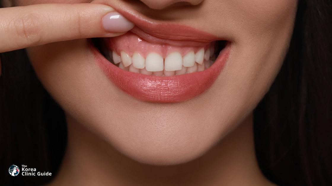 Gummy Smile Botox in Korea: Candidates, Results, Recovery, and Travel Planning