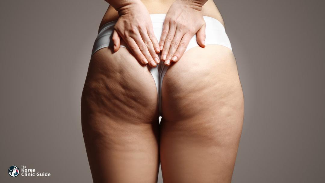 buttocks liposuction