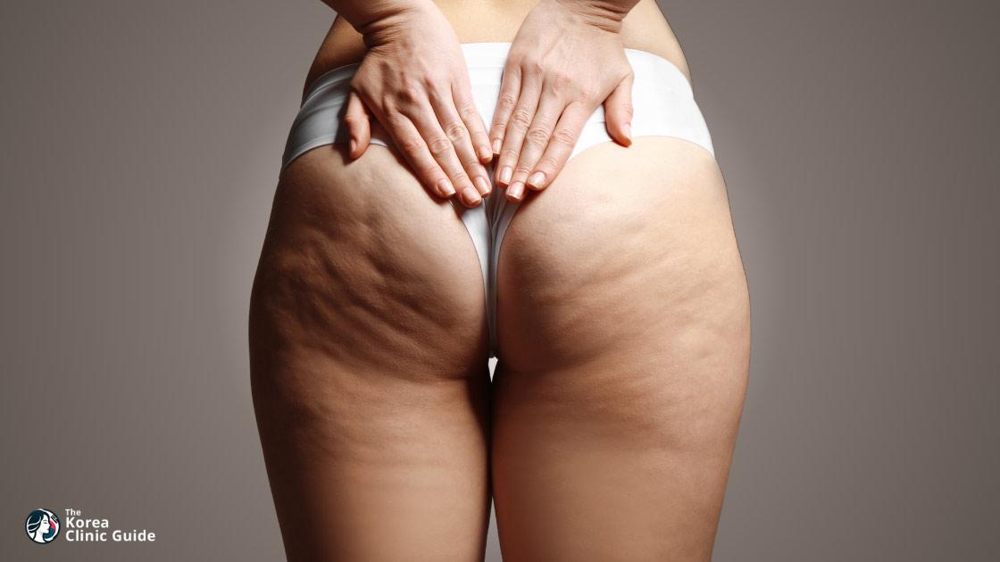 Buttocks Liposuction in Korea: Methods, Recovery, Risks and Travel Planning