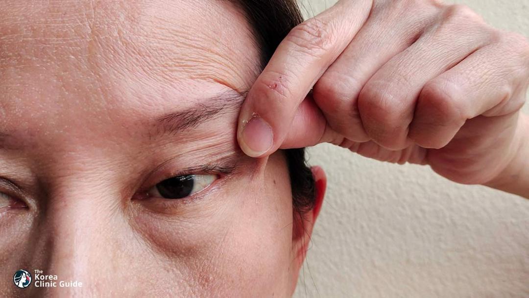 ptosis correction