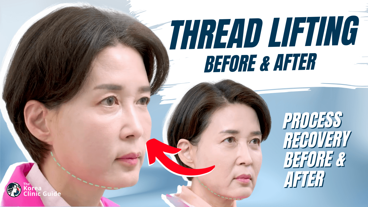 Thread Lifting Before After - PangPang