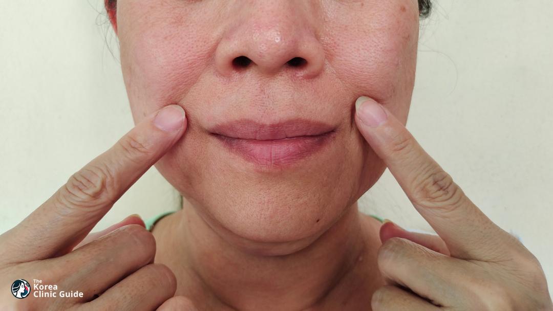 buccal fat removal