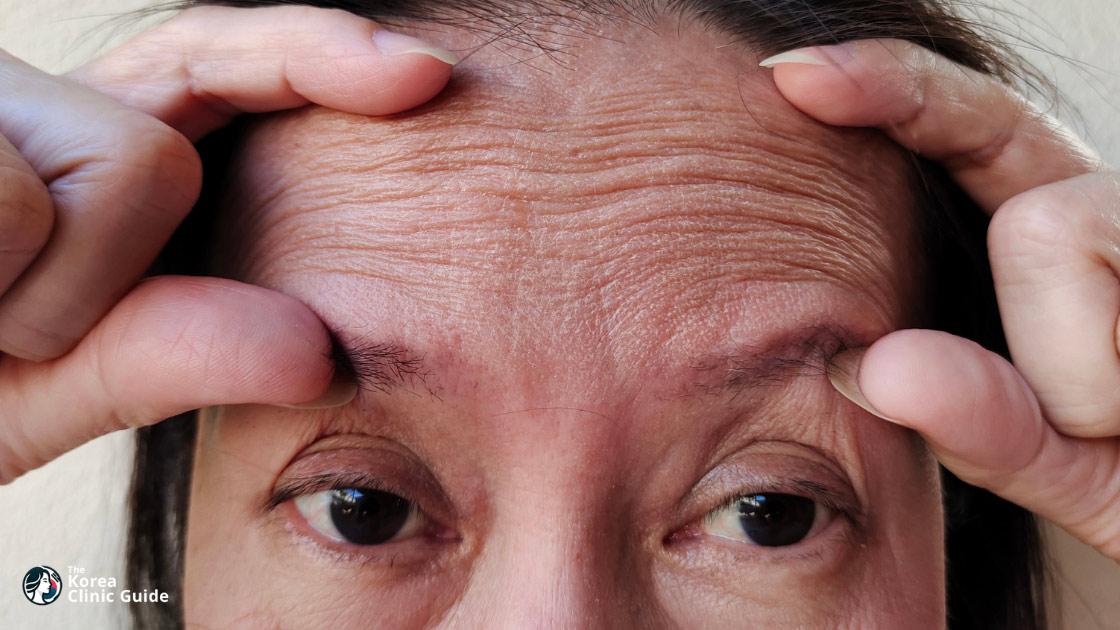 Forehead Lift in Korea: Methods, Recovery, Risks and Travel Planning