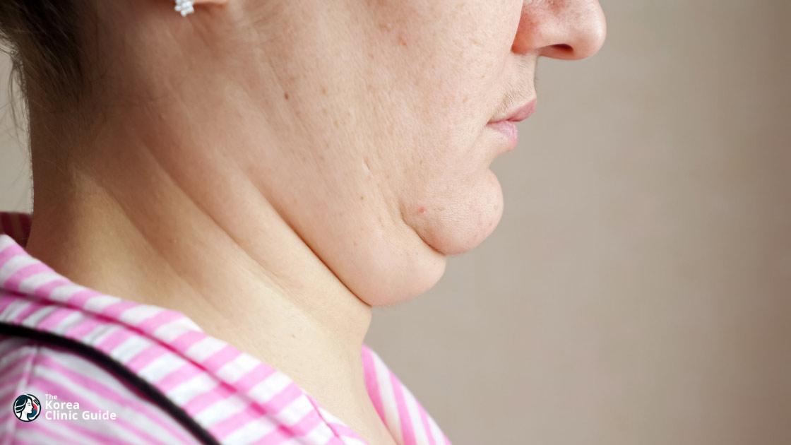 Double Chin Tightening in Korea | Costs, Procedure Types, Candidacy & Recovery