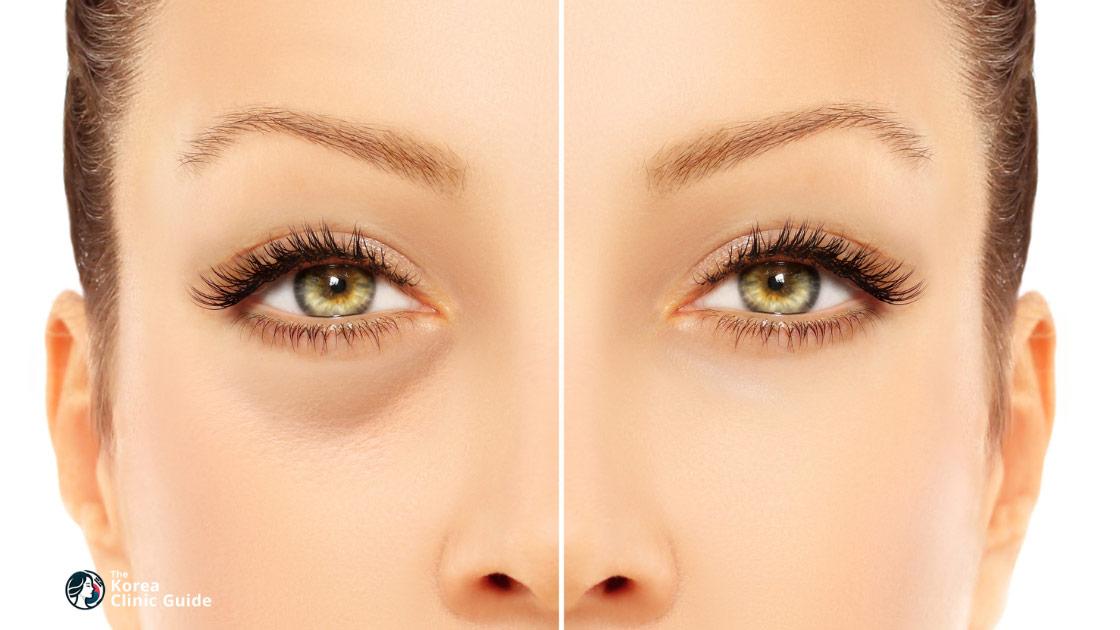 Under Eye Fat Grafting in Korea: Candidacy, Recovery, Risks, and Travel Planning